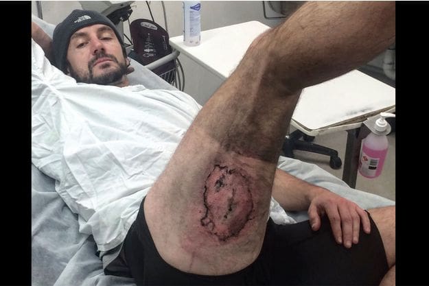 Australie: Un homme  brûlé au 3ème degré après que son iPhone a pris feu dans sa poche