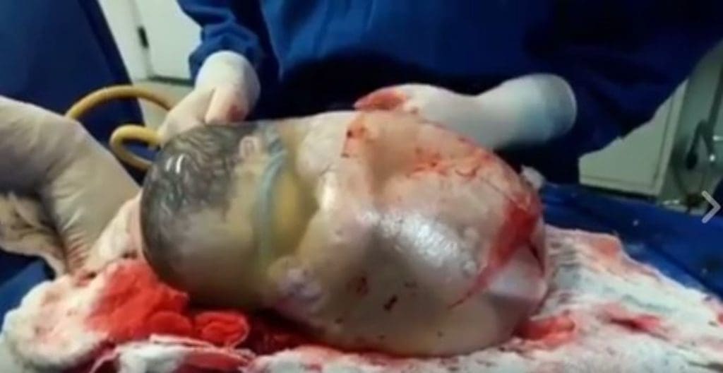 Espagne: Elle donne naissance à un bébé… il arrive dans son sac amniotique (vidéo)