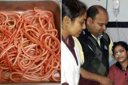 Inde: Elle se plaignait de maux de ventre… les chirurgiens lui retirent 150 vers de l’estomac