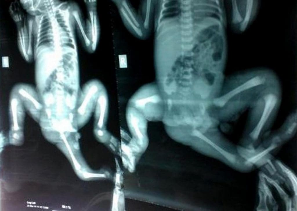 Bangladesh: La fillette aux trois jambes peut désormais marcher et courir (photo)