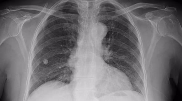 Intelligence artificielle: Un outil de diagnostic du cancer en Chine