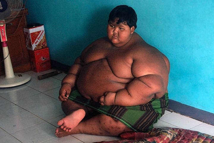 Indonésie: Arya Permana, l’enfant le plus gros du monde, opéré avec succès (vidéo)