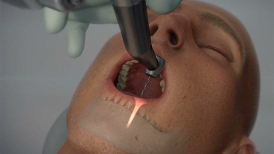 Première opération chirurgicale dentaire faite par un Robot (Vidéo)
