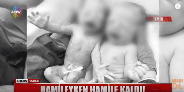 Turquie: Une femme enceinte… retombe enceinte (Vidéo)