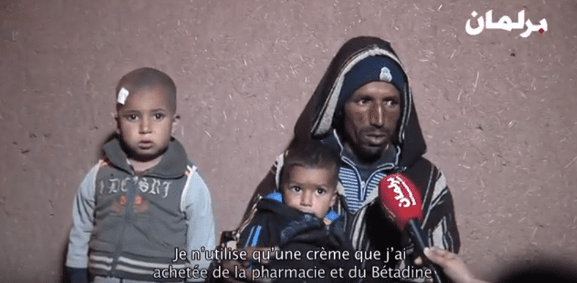 Enquête: La leishmaniose, une maladie mangeuse de chair fait des ravages au sud du Maroc