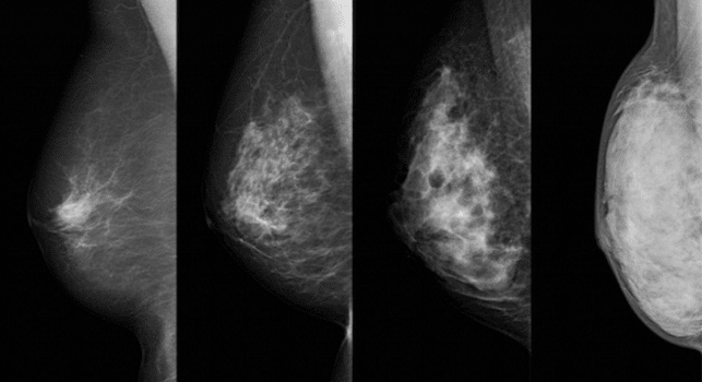Une campagne de dépistage du cancer du sein et du col utérin lancée à Fès