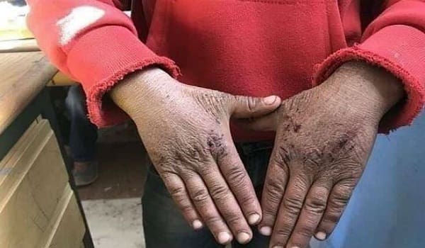 Une photo des mains gercées d’un élève à Azilal émeut la Toile