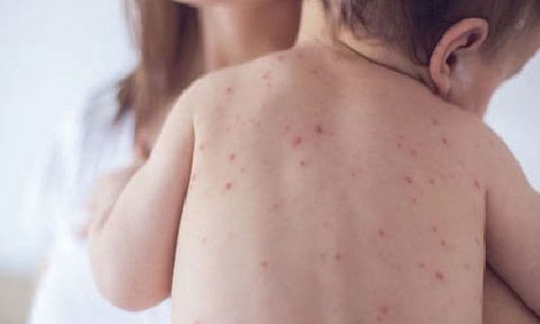 Le virus de la rougeole remet à zéro les défenses immunitaires