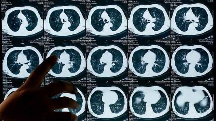 Novartis essuie un nouvel échec clinique pour un traitement contre le cancer du poumon
